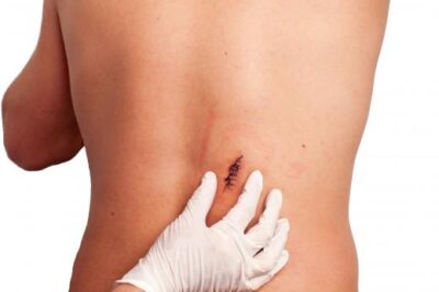 我真的可以使用强力胶来闭合伤口吗？