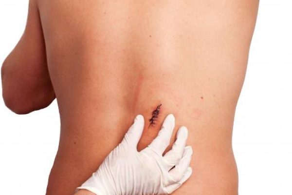 我真的可以使用强力胶来闭合伤口吗？