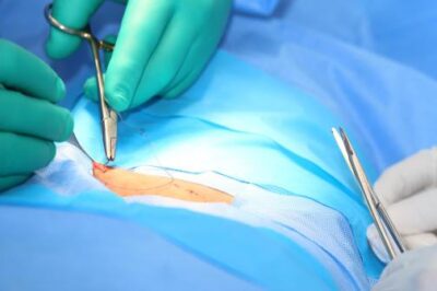 强力胶类似于经常用于粘合手术切口的氰基丙烯酸酯。