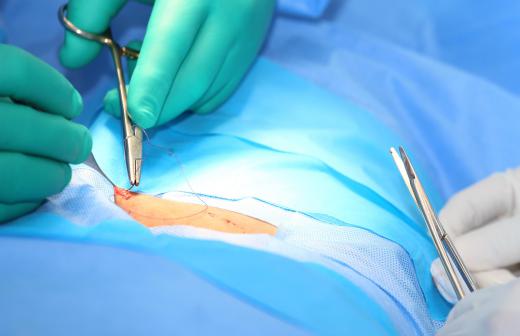 surgeon-using-needle-holder