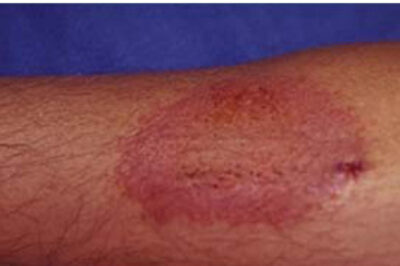 健康与安全——环氧树脂致敏化