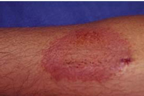 健康与安全——环氧树脂致敏化